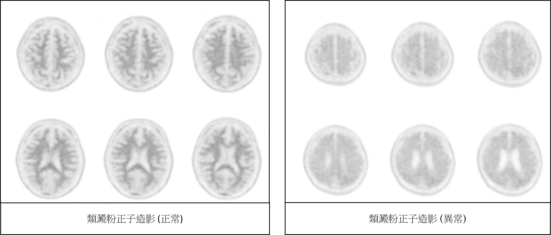 淺談腦部正子斷層掃描類澱粉正子造影